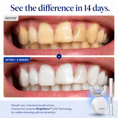 Oralume™ Advanced LED Whitening System